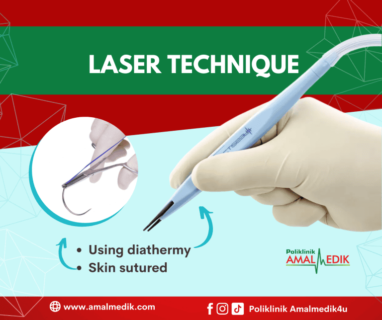 Circumcision For Male/Adult The Best Technique AmalMedikHq