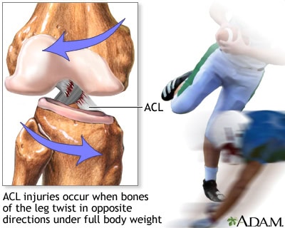 acl-tear