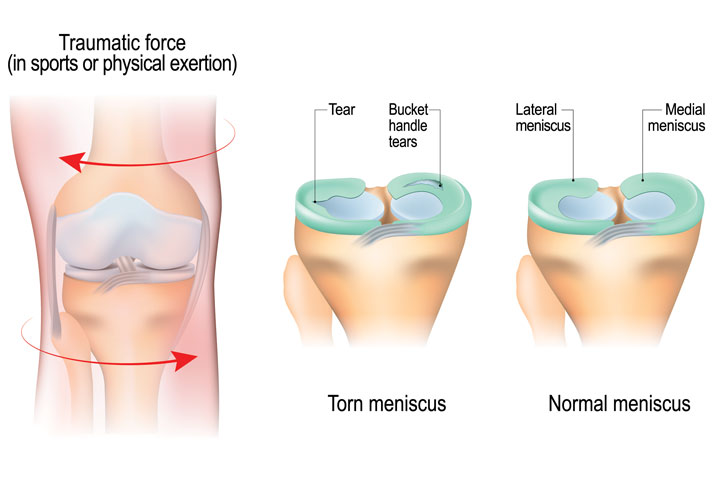 punca-sakit-lutut-meniscus-tear